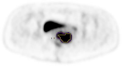 The Utility of PET/CT Metabolic Parameters Measured Based on Fixed Percentage Threshold of SUVmax and Adaptive Iterative Algorithm in the New Revised FIGO Staging System for Stage III Cervical Cancer